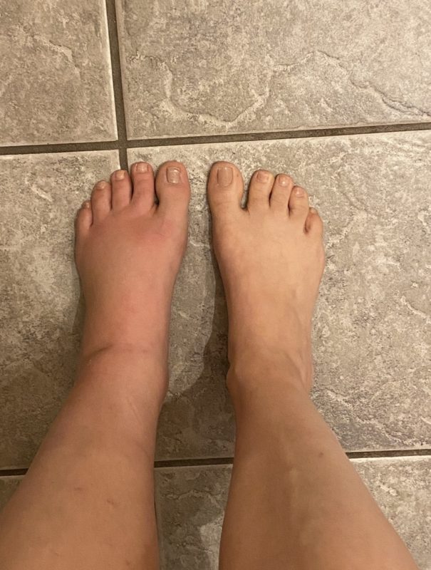 swollen foot.